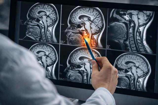 Doctor reviewing an MRI brain scan, focusing on the brain stem area