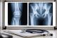 Orthopedic Surgery Malpractice in Georgia: Common Errors and How to Pursue a Claim